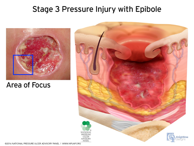 bed sore injury attorney Phoenix